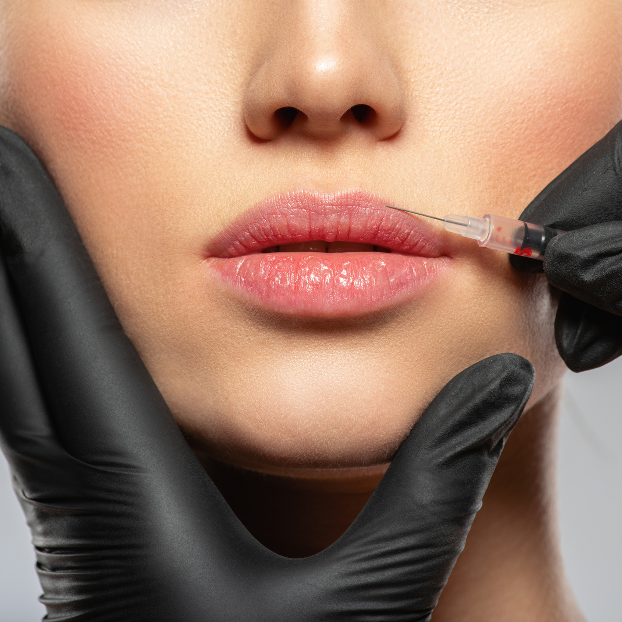 Caucasian Woman Getting Botox Cosmetic Injection in the Lips. Wo